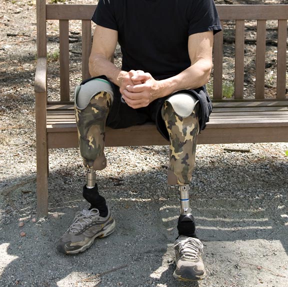 Innovative Prostheses Are Giving More Independence to Wearers