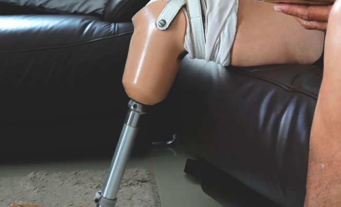 what-to-do-if-a-prosthetic-socket-breaks