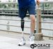 Prosthetic Technology Advancements: Key Insights