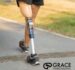 Prosthetic Leg Sockets: How Fit Affects Patient Mobility